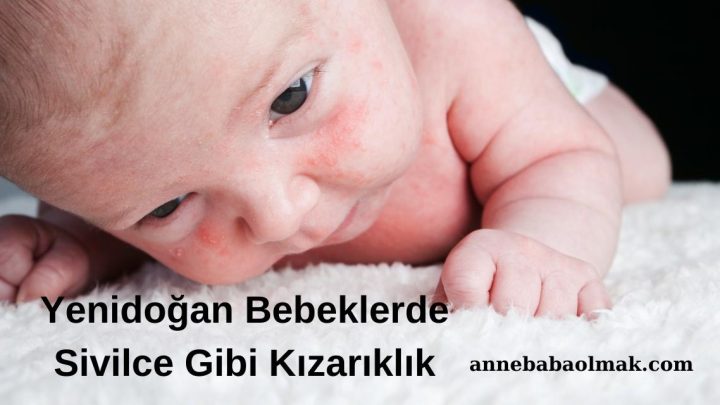 Yenidoğan Bebeklerde Sivilce Gibi Kızarıklık